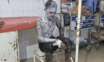 सदर अस्पताल में झुलसा हुआ युवक