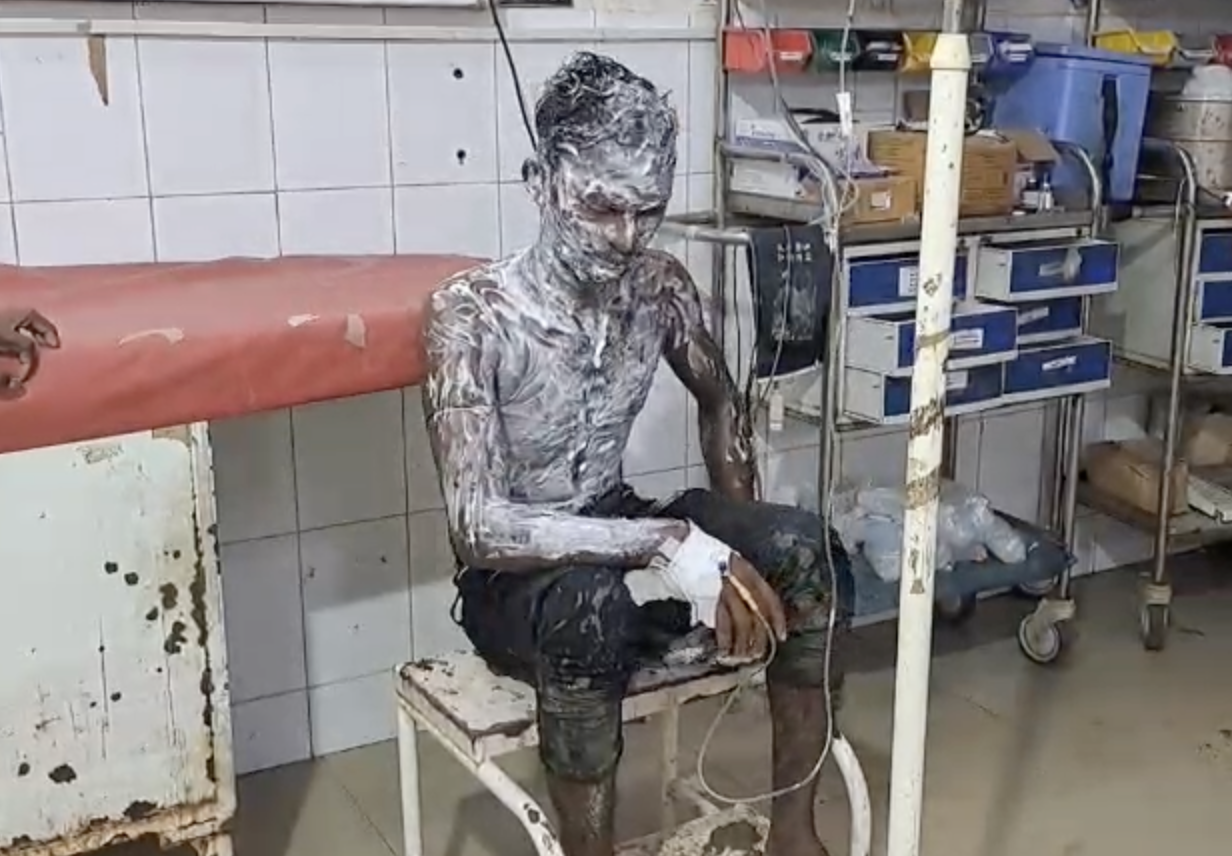 सदर अस्पताल में झुलसा हुआ युवक