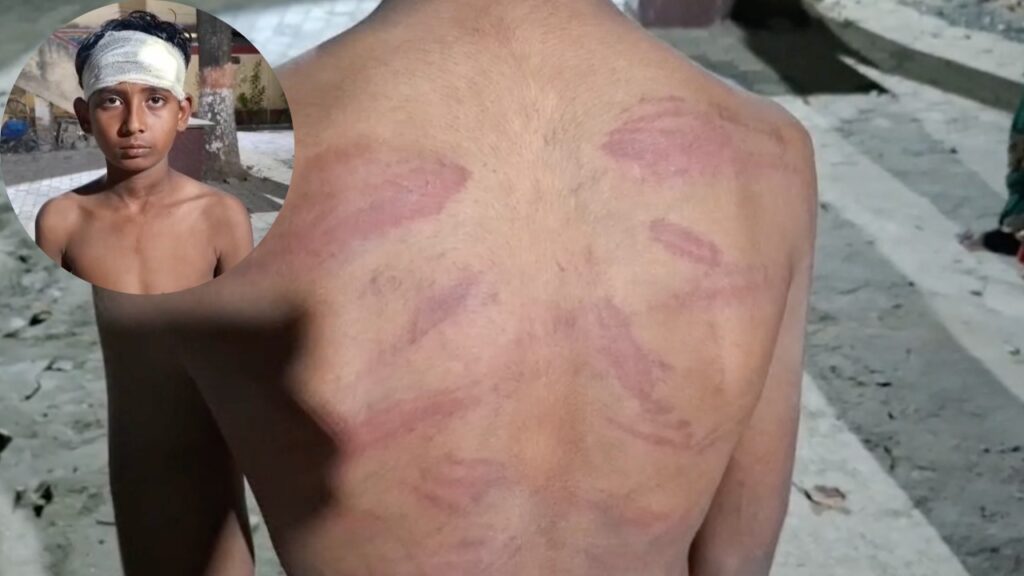 वैशाली में डंडे की पिटाई से बच्चा बुरी तरह घायल हो गया।