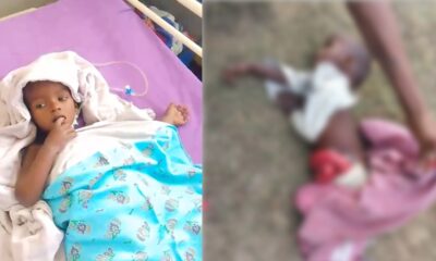 बच्चे के पेट से आंतें बाहर निकल आई थीं, वह नदी किनारे लावारिस मिला। पटना में हुए ऑपरेशन के बाद बच्चा स्वस्थ है।